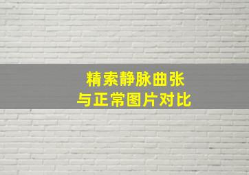 精索静脉曲张与正常图片对比